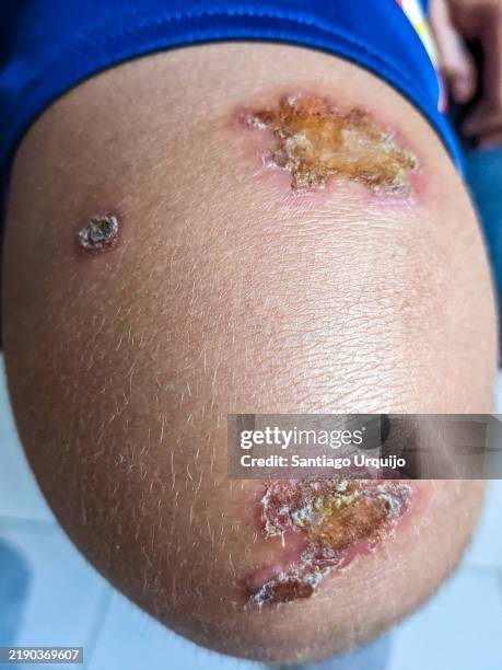 impetigo sores on a child's knee - impetigo stock pictures, royalty-free photos & images