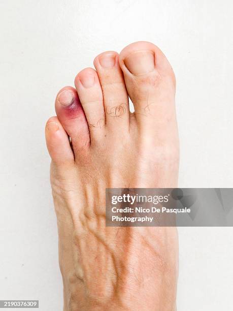 high angle view of male feet with broken and bruised toe - orteil photos et images de collection