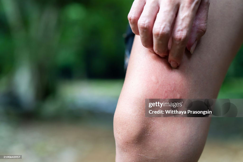 Person Scratching Redness on Skin in Natural Outdoor Environment