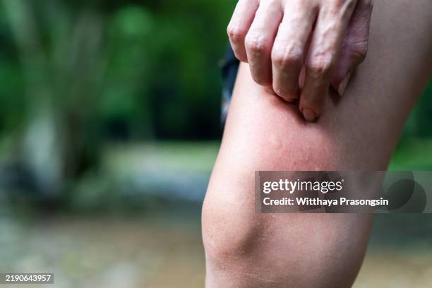 person scratching redness on skin in natural outdoor environment - zanzara foto e immagini stock
