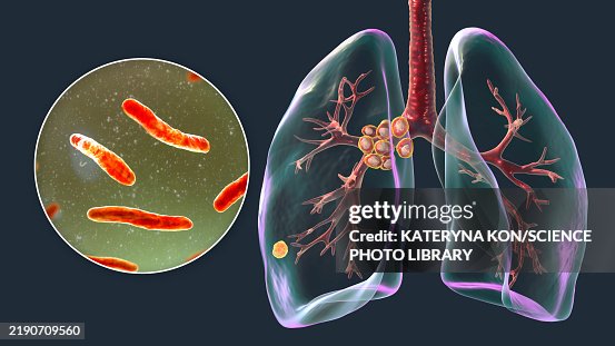 Primary Lung Tuberculosis With Ranke Complex Illustration High-Res ...
