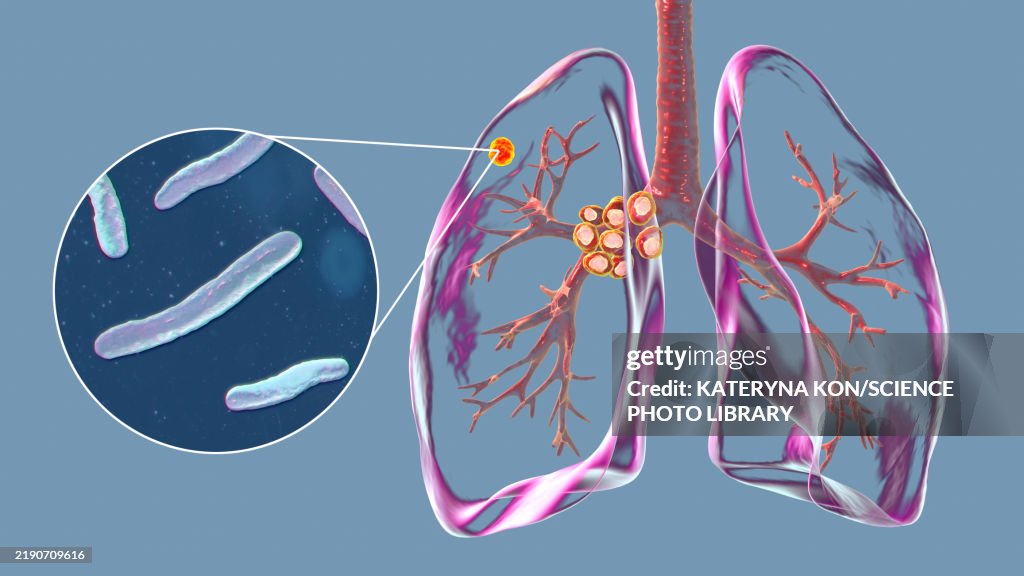 Primary Lung Tuberculosis With Ranke Complex Illustration High-Res ...