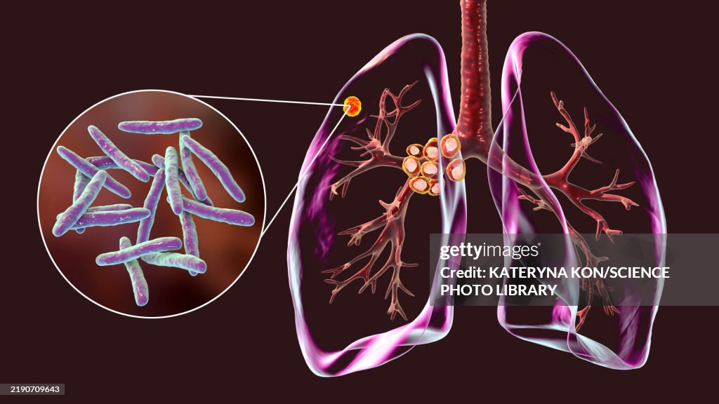 Primary Lung Tuberculosis With Ranke Complex Illustration High-Res ...