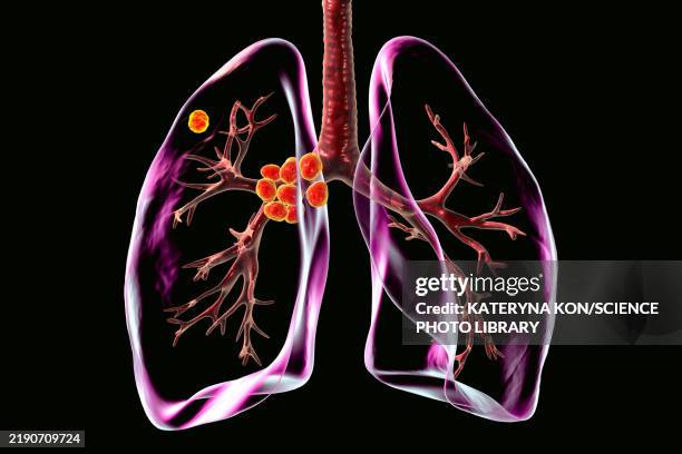 primary lung tuberculosis, illustration - tuberculosis bacterium stock illustrations