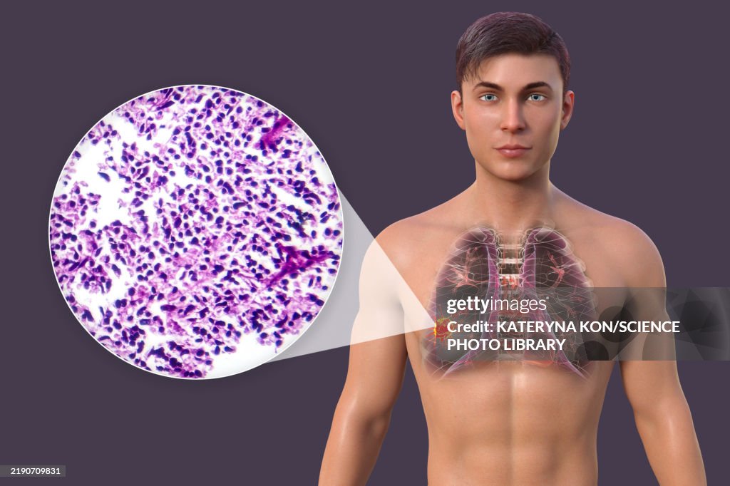 Man with lung cancer, illustration and light micrograph