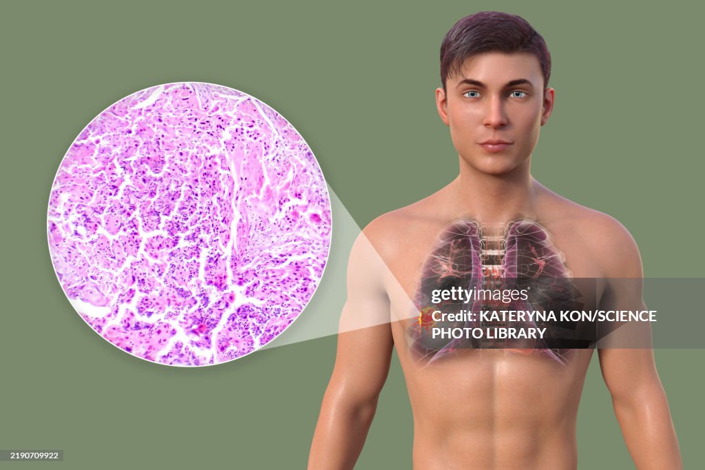 Man with lung cancer, illustration and light micrograph
