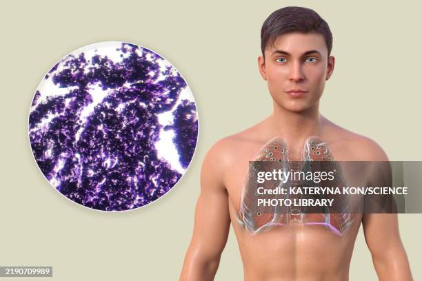 man with lung silicosis, illustration and light micrograph - light micrograph stock illustrations
