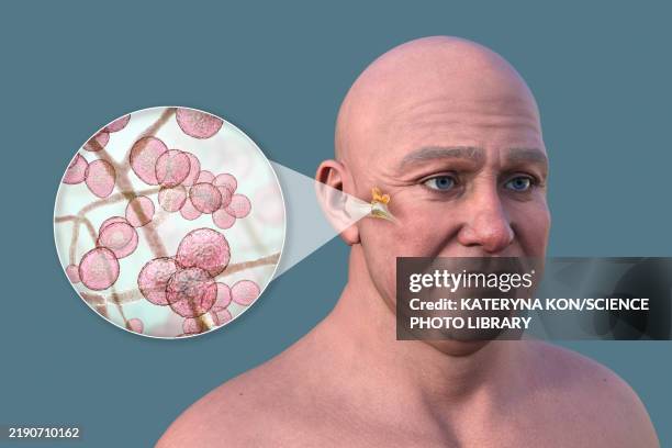 ilustraciones, imágenes clip art, dibujos animados e iconos de stock de otitis media in a man, illustration - aftas