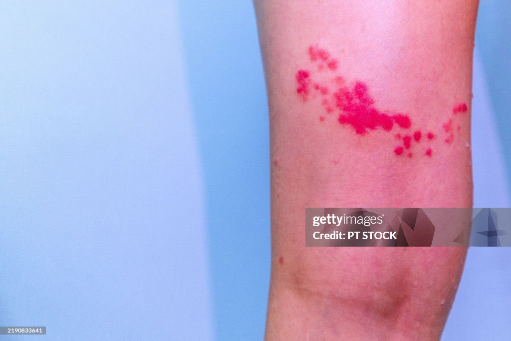 Dpar Rash Skin Closeup Of Red Rash With Inflammation On Human Skin Showing Symptoms Of ...
