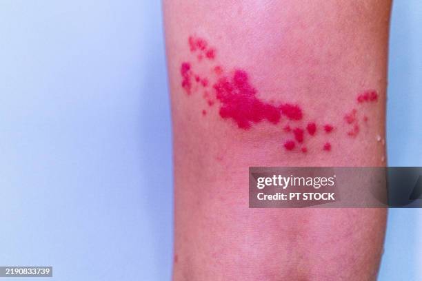 Upmit Rash 112 Foot Rash Stock Photos, High-Res Pictures, and Images - Getty Images