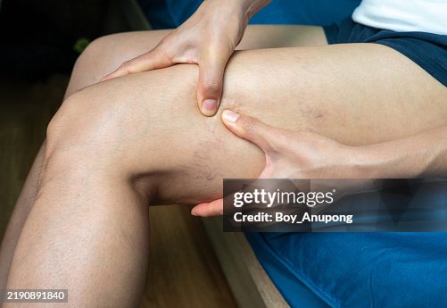 Cropped shotview of woman having spider veins occur on her thigh. In some cases, severe varicose veins can lead to serious health problems, such as blood clots. Cropped shotview of woman having spider veins occur on her thigh. In some cases, severe varicose veins can lead to serious health problems, such as blood clots.