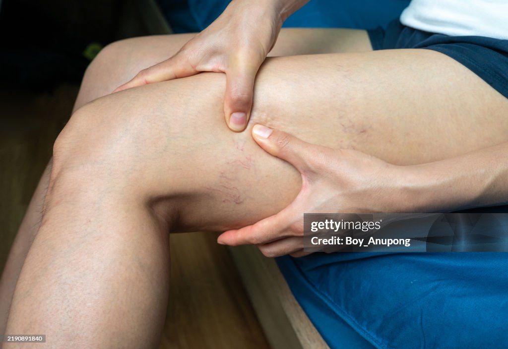 Cropped shotview of woman having spider veins occur on her thigh. In some cases, severe varicose veins can lead to serious health problems, such as blood clots.