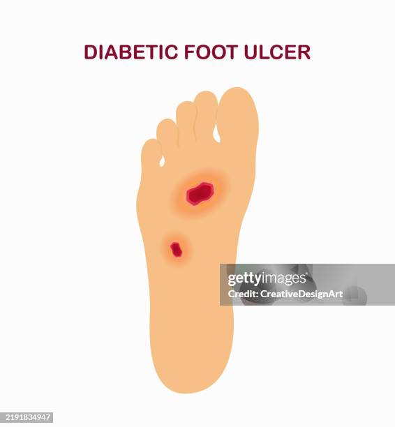 diabetic foot ulcers. sole of foot with skin sores and ulcers - diabetic blister stock illustrations