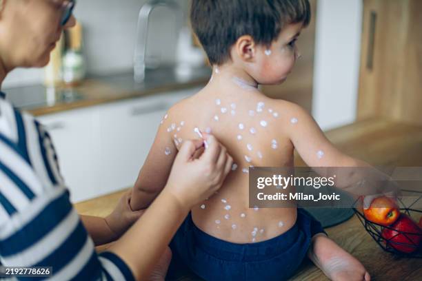 mother taking care of her son with chicken pox - chickenpox stock pictures, royalty-free photos & images