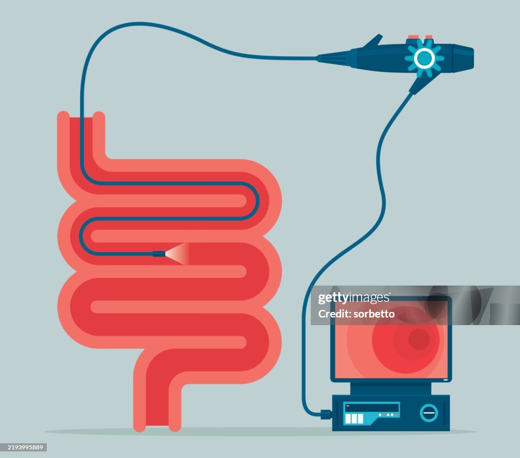 Esophagogastroduodenoscopy medical procedure