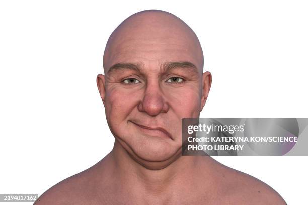 stockillustraties, clipart, cartoons en iconen met left-side stroke, illustration - ischemische beroerte