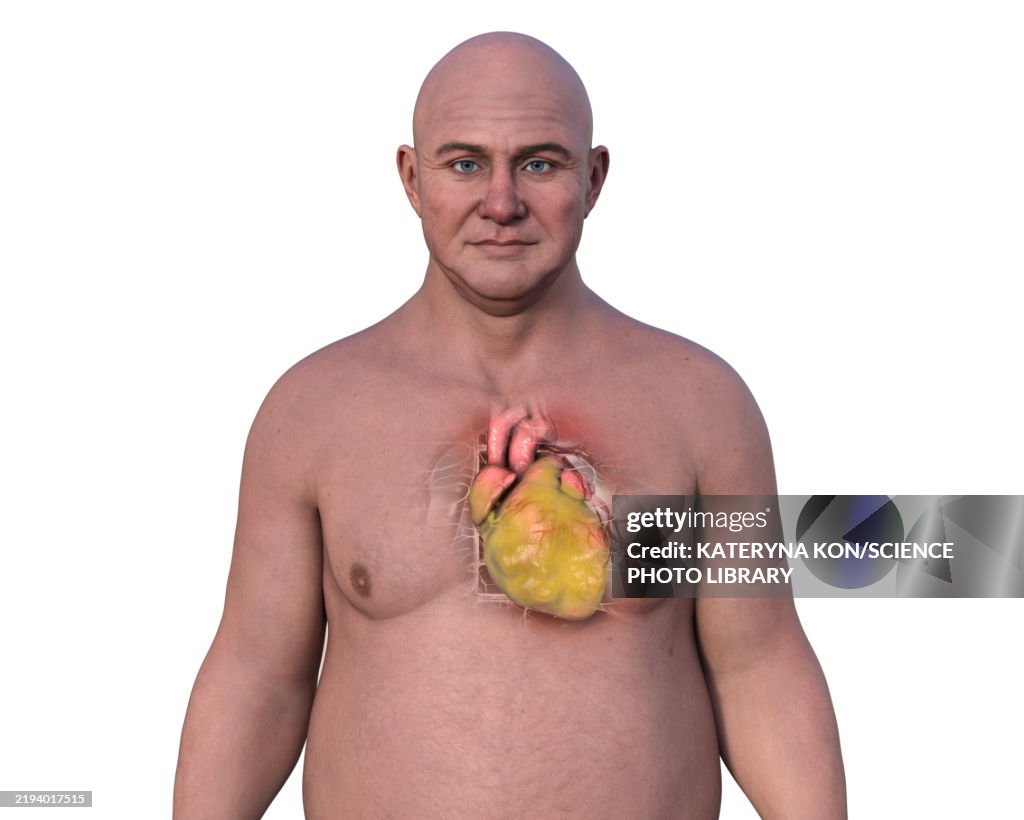 Man with fatty heart, illustration