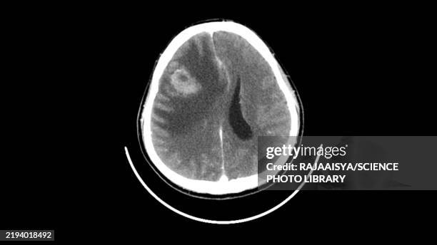 brain tumour, ct scan - parenchyma stock pictures, royalty-free photos & images
