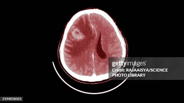 brain tumour, ct scan - parenchyma stock pictures, royalty-free photos & images