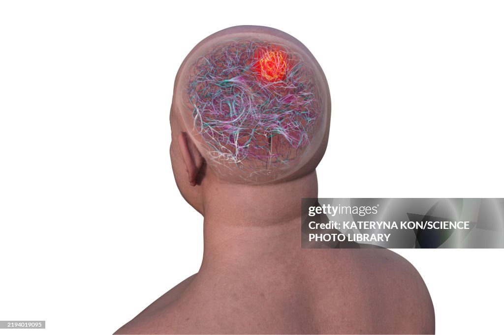 Brain tumour, illustration
