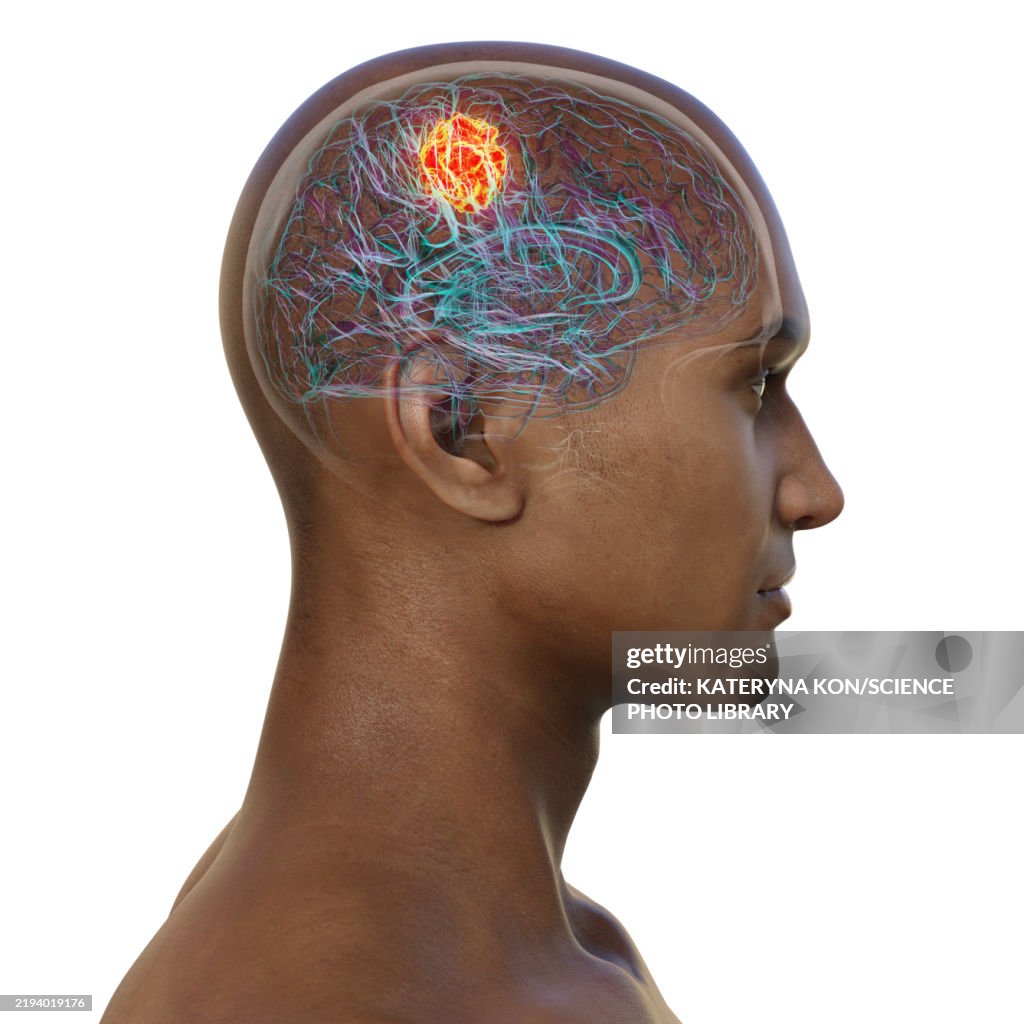Brain tumour, illustration