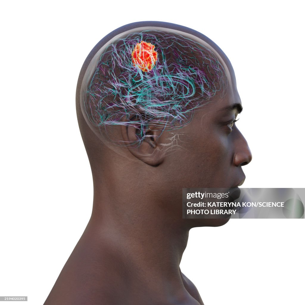 Brain tumour, illustration