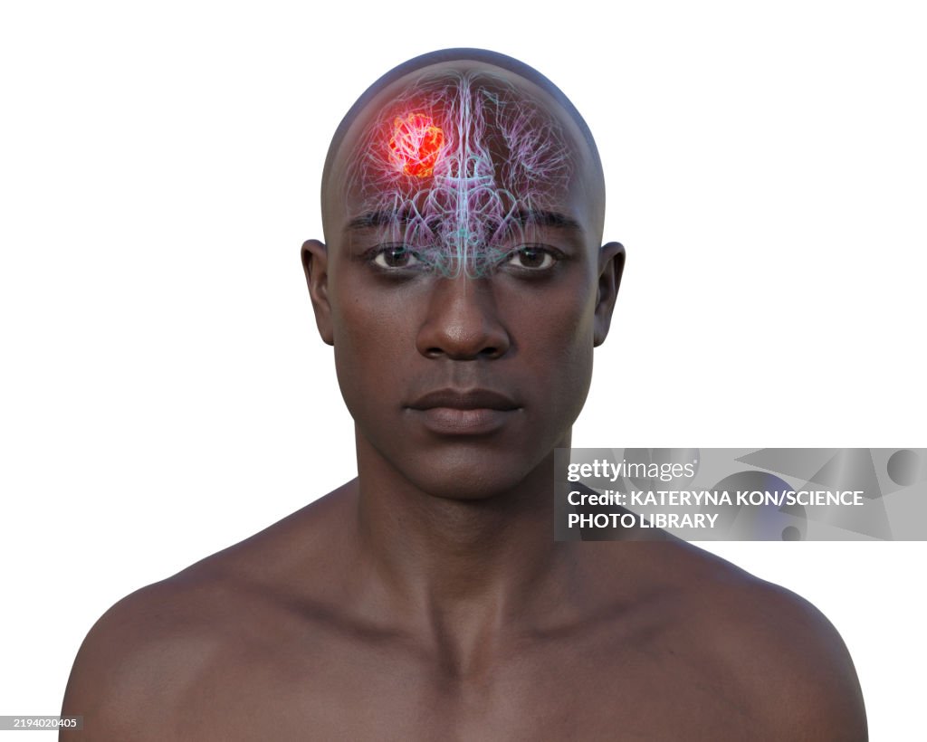Brain tumour, illustration