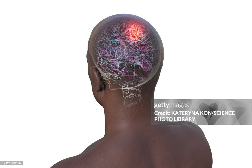 Brain tumour, illustration