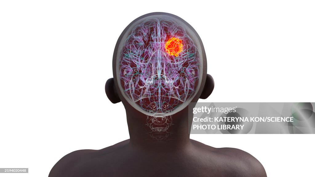 Brain tumour, illustration