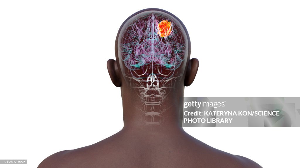 Brain tumour, illustration