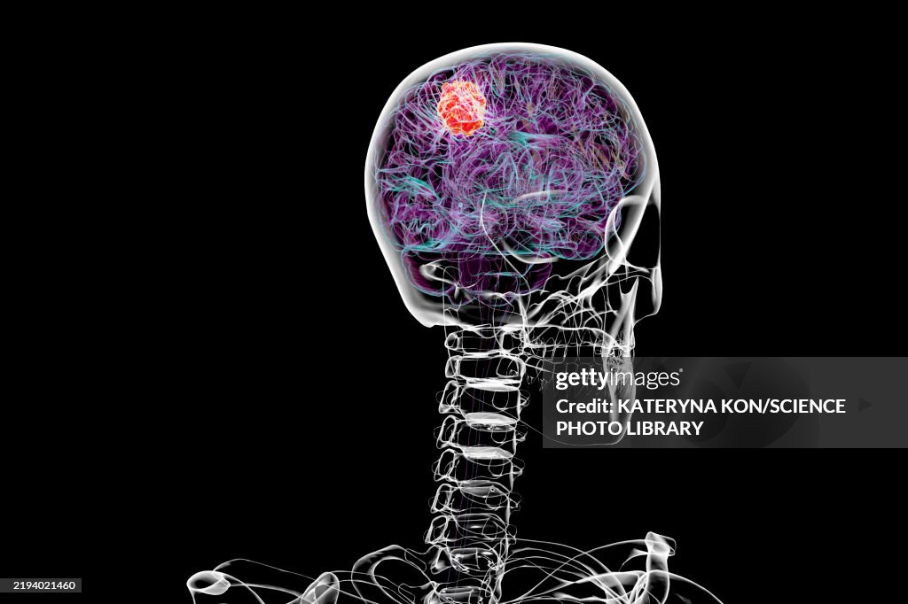 Brain tumour, illustration