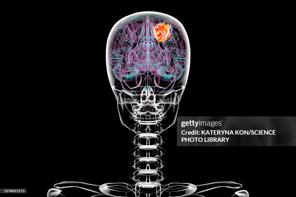 Brain tumour, illustration