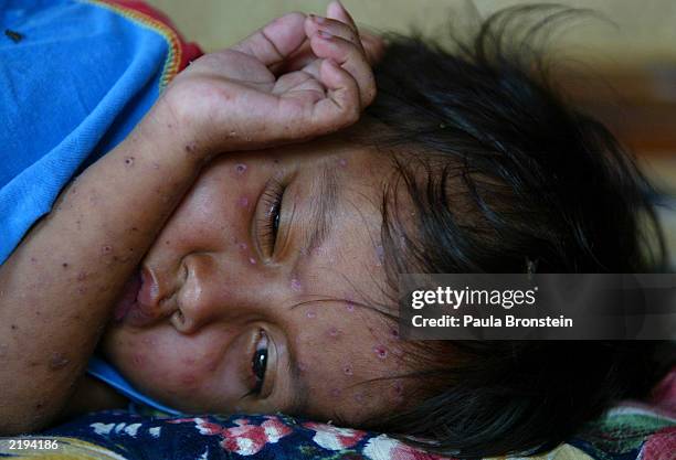 Five-year-old AIDS patient Nam Samadie suffers from Chicken pox at the Little Sprouts group home for children with AIDS July 24, 2003 in Phnom Penh,...