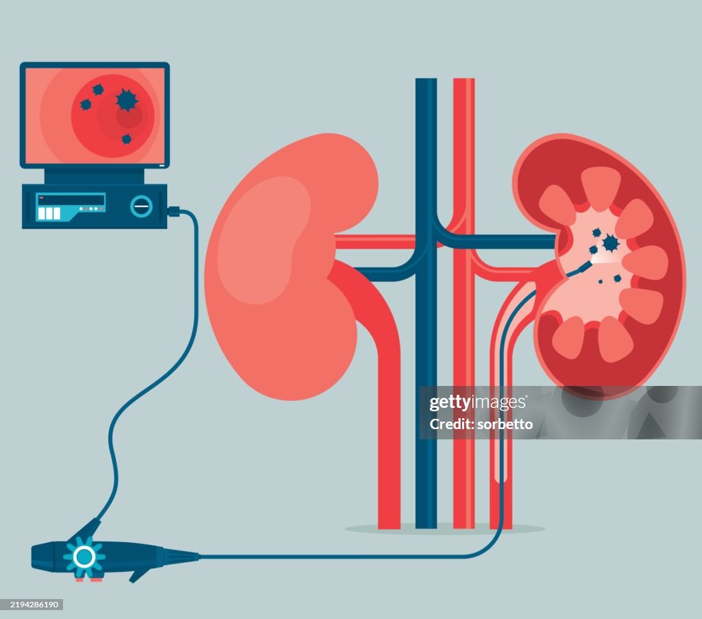 Ureteroscopy medical