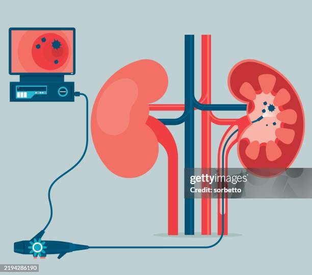 stockillustraties, clipart, cartoons en iconen met ureteroscopy medical - nierbekkenontsteking