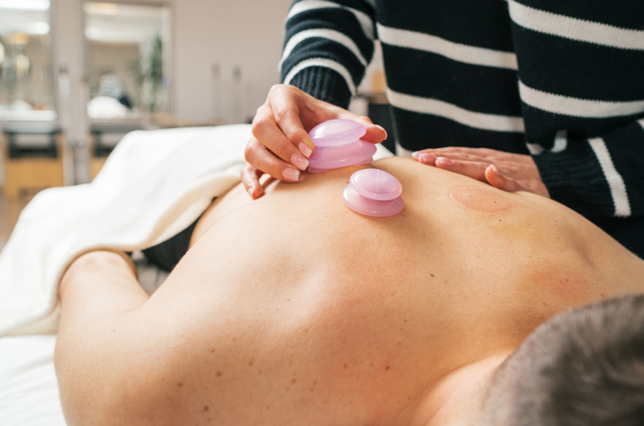 Therapist's hands performing vacuum cupping therapy treatment on female patient's skin. Image highlights relaxation and alternative medicine healthcare practices in traditional oriental clinic. Therapist's hands performing vacuum cupping therapy treatment on female patient's skin. Image highlights relaxation and alternative medicine healthcare practices in traditional oriental clinic.