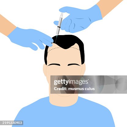 Hair Transplant Illustration Hair Transplant Illustration