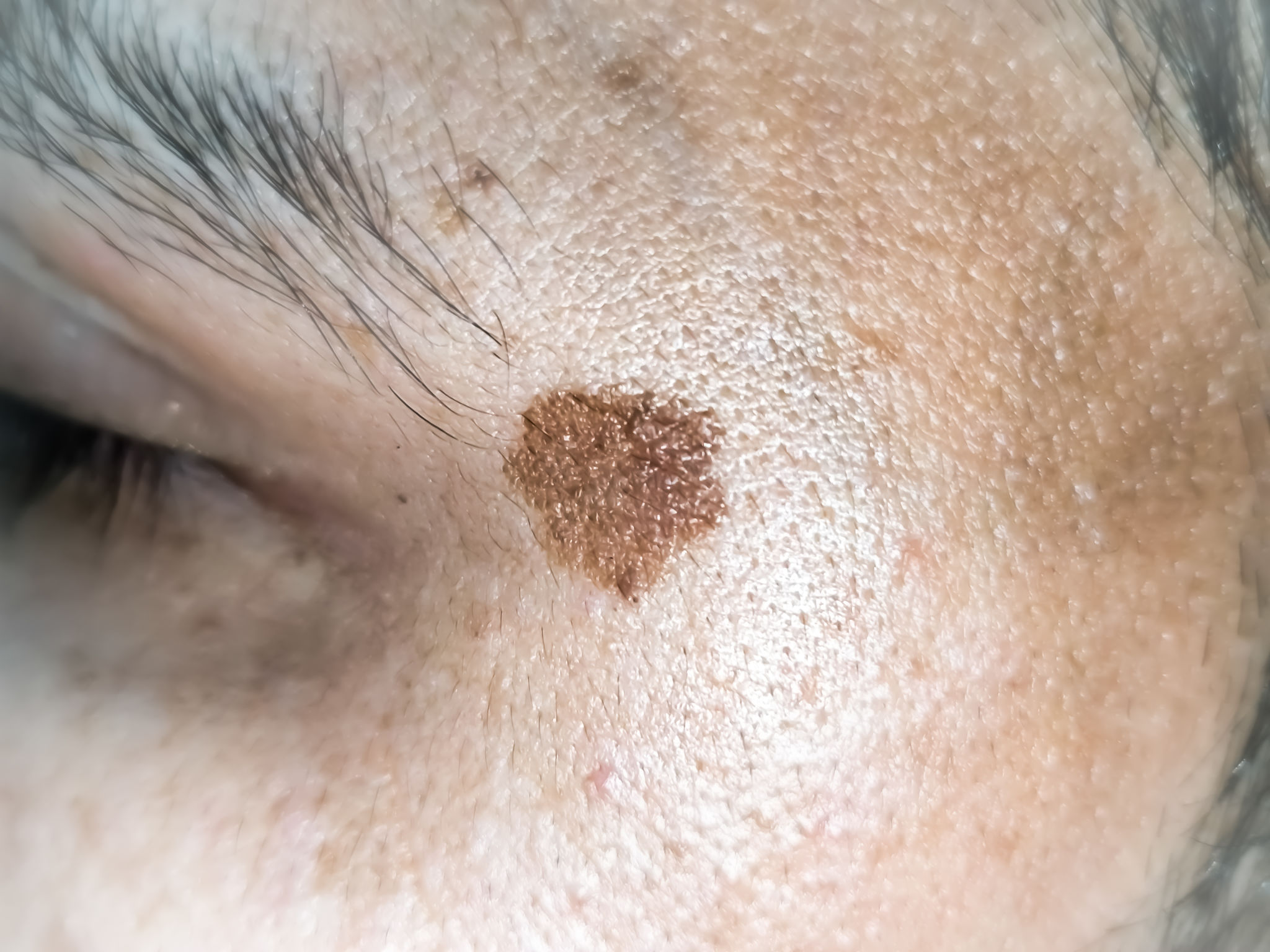 laser treatment