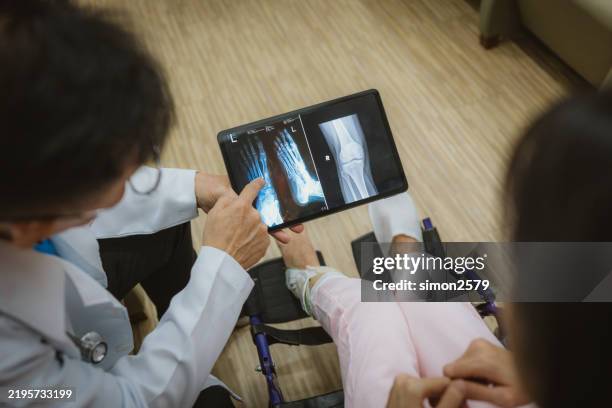 doctor reviewing x-ray for patient with broken leg in hospital - orthopedische apparatuur stockfoto's en -beelden