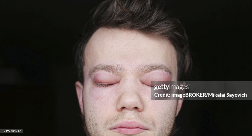 A person with both eyes closed, showing a calm expression in moderate lighting Real allergic reaction in a man face, eyes, nose. Dangerous disease Angioedema