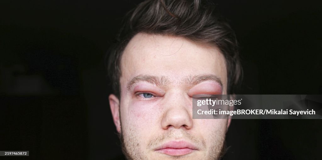 A person with a swollen eye partially closed in moderate lighting allergic reaction on the lip angioedema in a man, consequences of hyaluronic acid injections