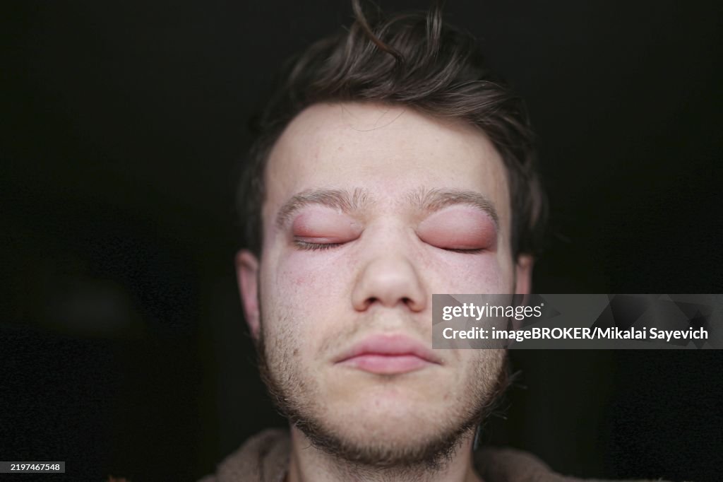 A man with closed swollen eyes, conveying rest and relaxation in a peaceful state Real allergic reaction in a man face, eyes, nose. Dangerous disease Angioedema