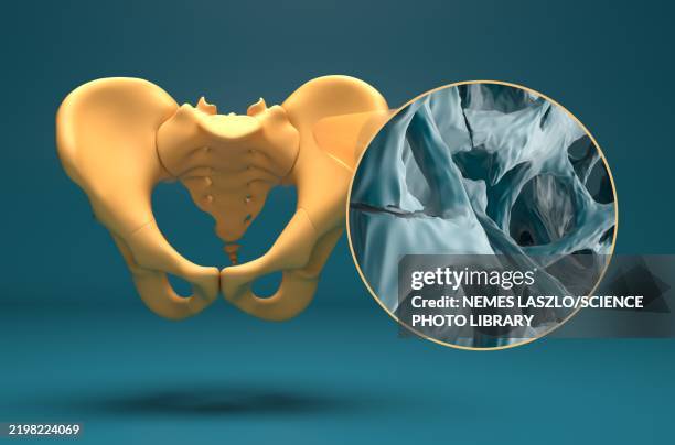 fractures in osteoporotic bone tissue, illustration - osteoporose stock-grafiken, -clipart, -cartoons und -symbole