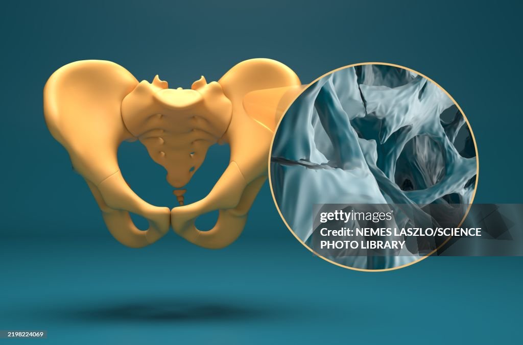 Fractures in osteoporotic bone tissue, illustration