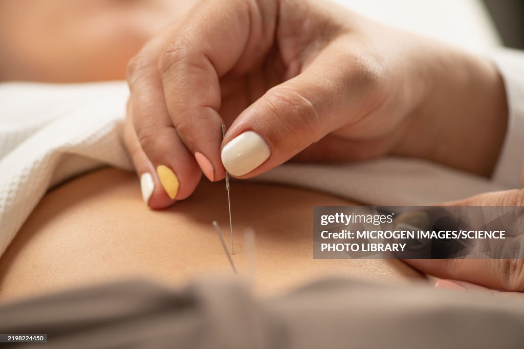 Acupuncturist stimulating stomach acupuncture points