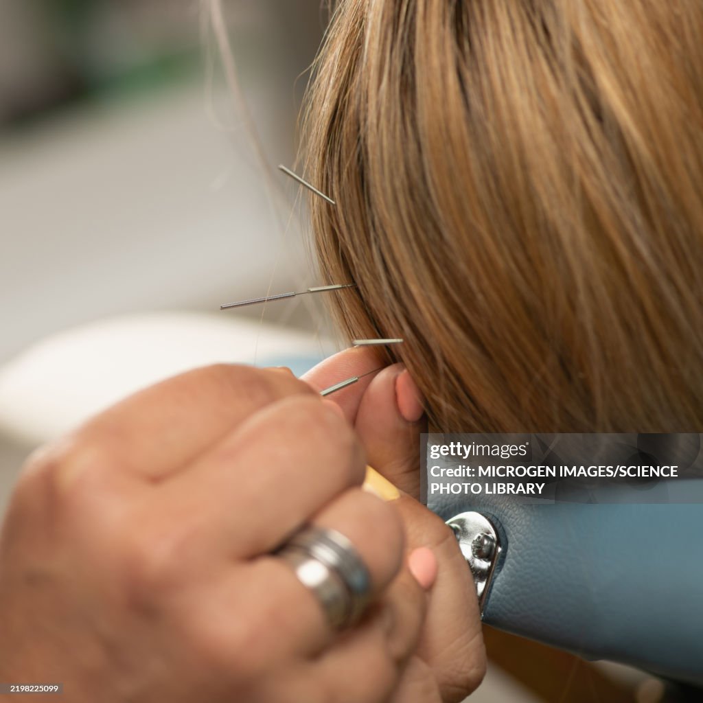 Acupuncturist applying needles into loose areolar tissue