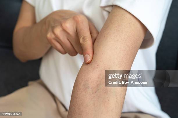 cropped shot view of rashes occur on person skin. skin rashes can be red, inflamed, bumpy as well as dry, itchy or painful. - holprig stock-fotos und bilder