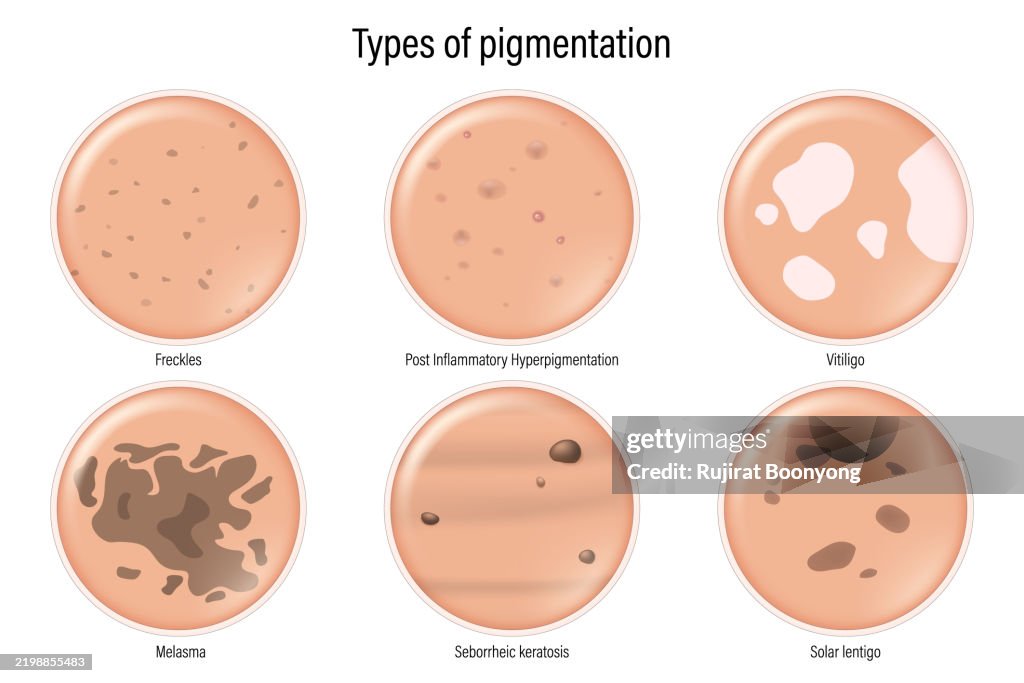 Types Of Pigmentation Freckles Post Inflammatory Hyperpigmentation ...