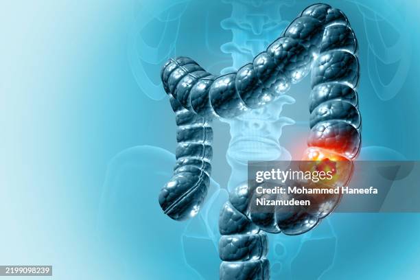 Genentech's Tecentriq gains new indication for colon cancer | Seeking Alpha