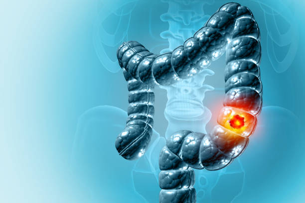 Colon Dysfunction Genentech's Tecentriq gains new indication for colon cancer | Seeking Alpha
